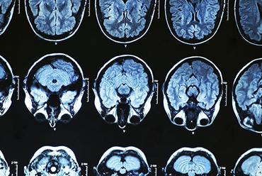 Mal de Alzheimer - Diagnostico